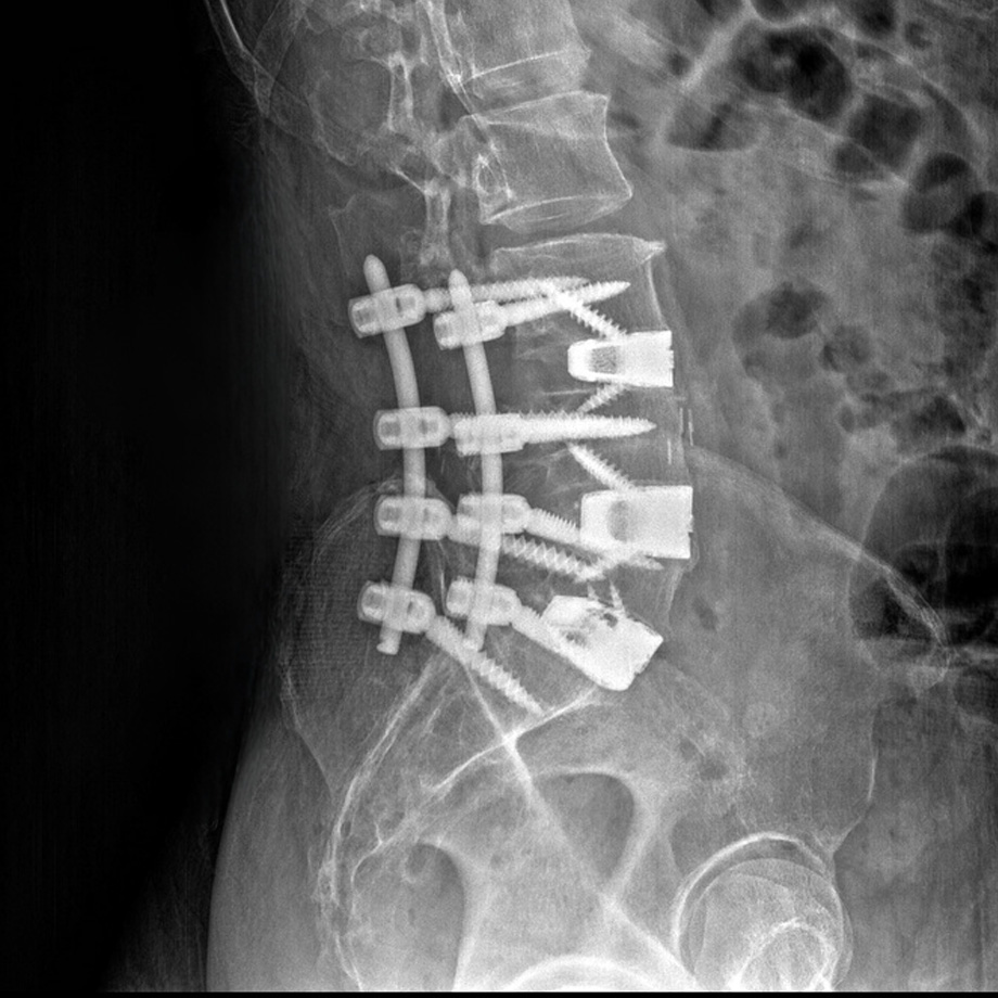 Spine Scan 1