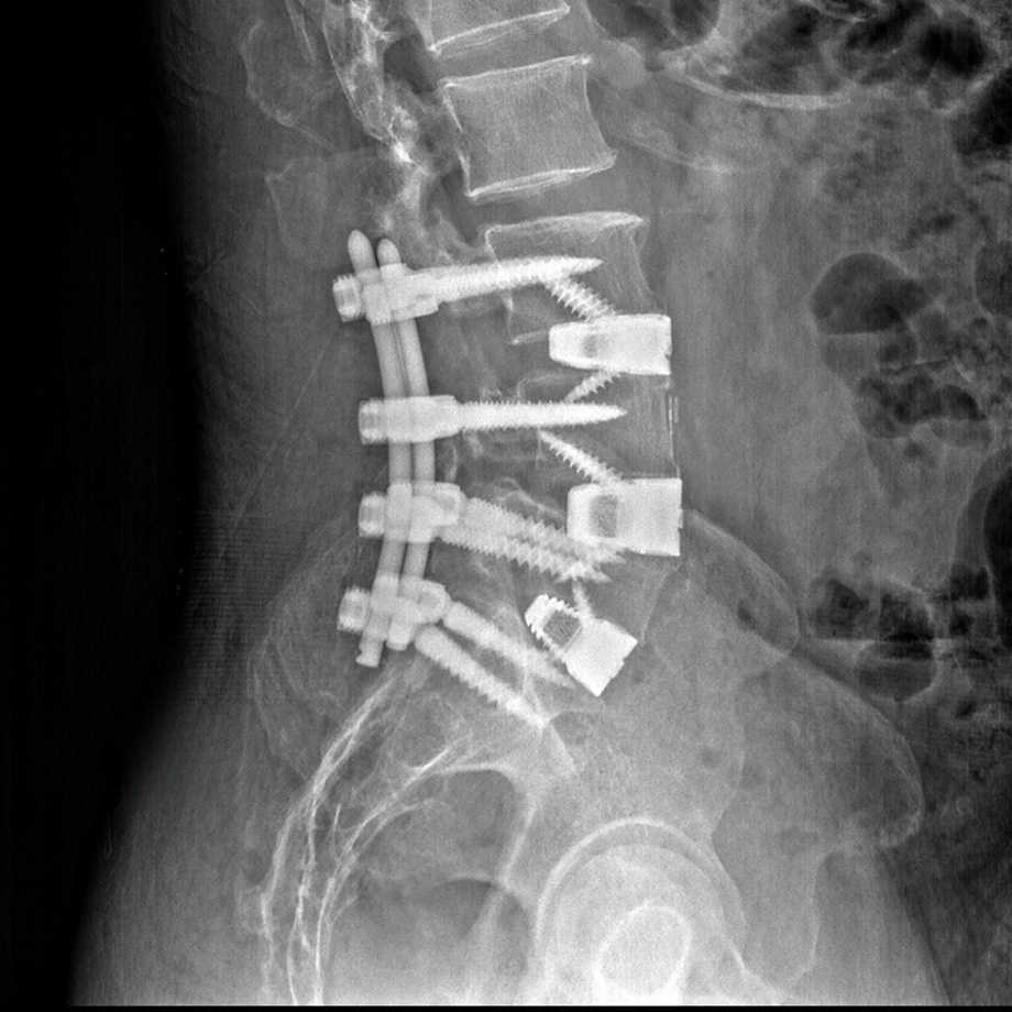 Spine Scan 2