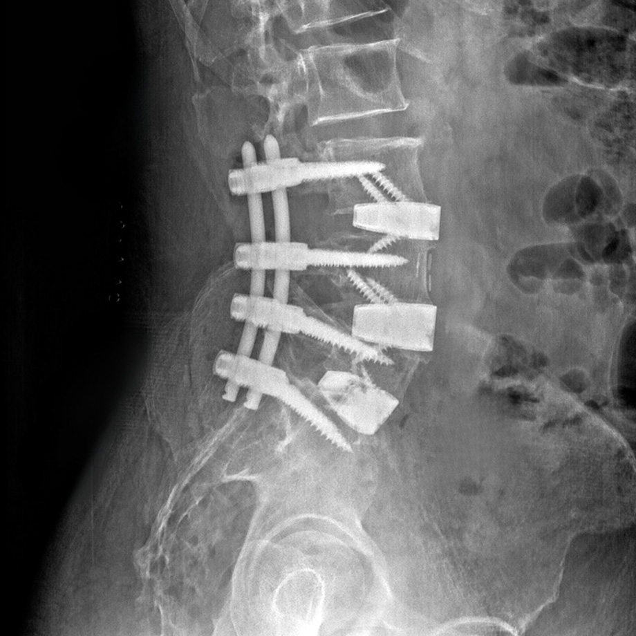 Spine Scan 3