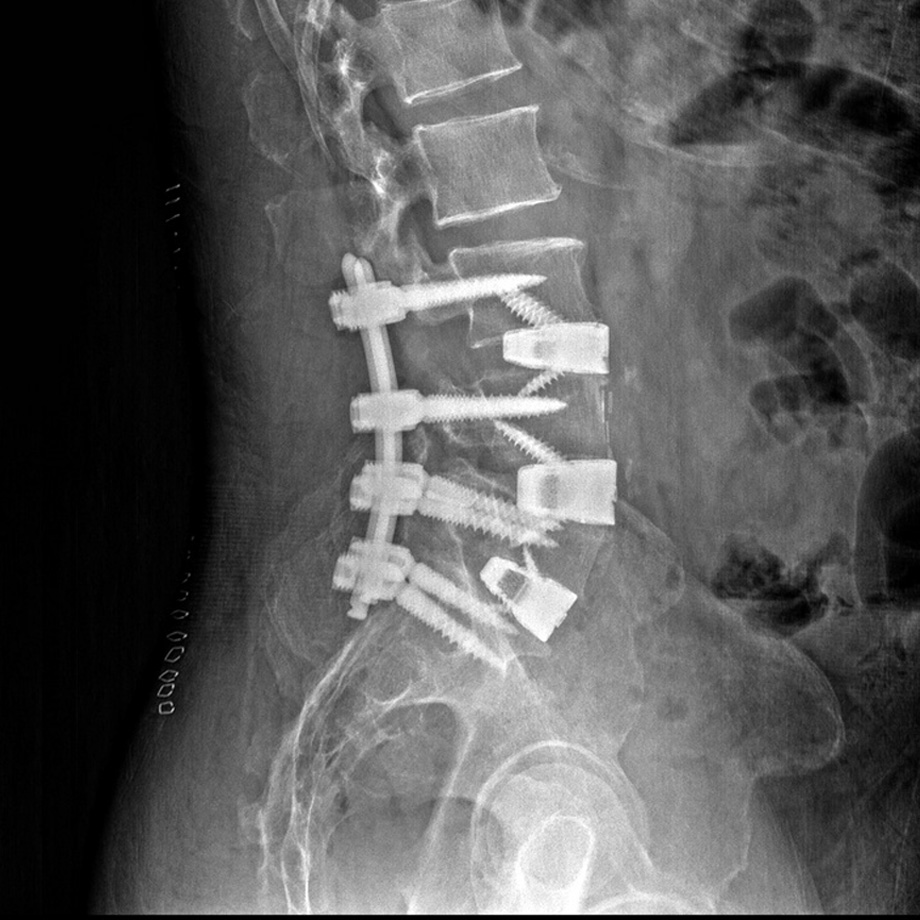 Spine Scan 4