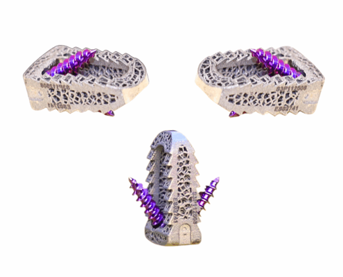 Revised Screw Posterior Image