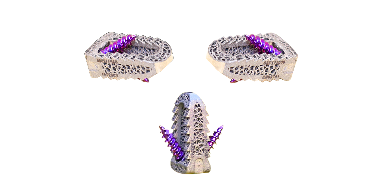 Revised Screw Posterior Image